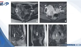 Dolor p&eacute;lvico c&iacute;clico en adolescente de 14 a&ntilde;os revela rara masa uterina accesoria cavitada 