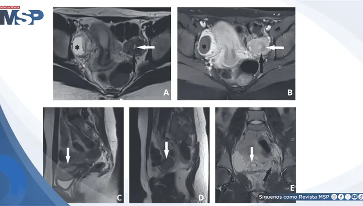 Dolor p&eacute;lvico c&iacute;clico en adolescente de 14 a&ntilde;os revela rara masa uterina accesoria cavitada 
