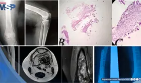 Dolor de rodilla por lo que parec&iacute;a un quiste benigno, result&oacute; ser una infecci&oacute;n parasitaria del hueso