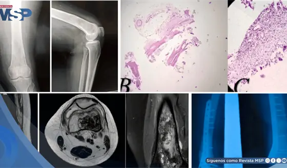 Dolor de rodilla por lo que parec&iacute;a un quiste benigno, result&oacute; ser una infecci&oacute;n parasitaria del hueso
