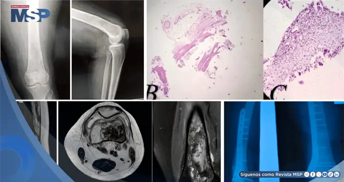 Dolor de rodilla por lo que parec&iacute;a un quiste benigno, result&oacute; ser una infecci&oacute;n parasitaria del hueso