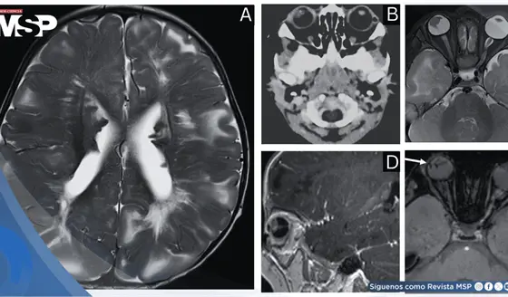 Pupila blanca en lactante revela esclerosis tuberosa y desprendimiento de retina 