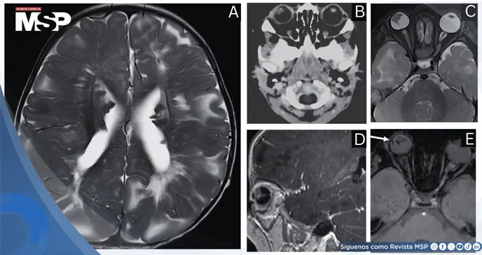 Pupila blanca en lactante revela esclerosis tuberosa y desprendimiento de retina 