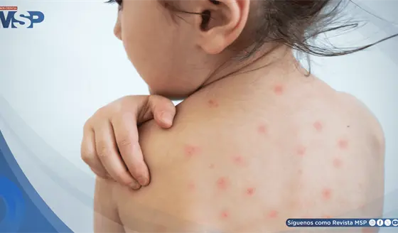 &iquest;Por qu&eacute; el sarampi&oacute;n es altamente contagioso? Estas podr&iacute;an ser sus complicaciones