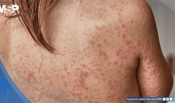 Estados Unidos supera los 900 casos de sarampi&oacute;n en 2026 y el brote ya afecta a 24 estados