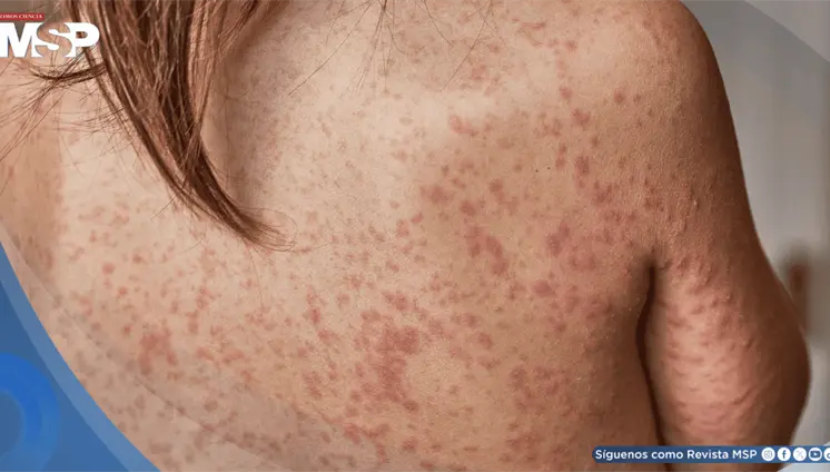 Estados Unidos supera los 900 casos de sarampi&oacute;n en 2026 y el brote ya afecta a 24 estados