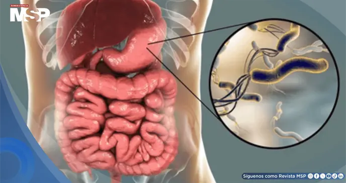 La erradicación de H. pylori reduce riesgo de cáncer gástrico en todas las edades, incluso en mayores La erradicación de H. pylori reduce riesgo de cáncer gástrico en todas las edades, incluso en mayores