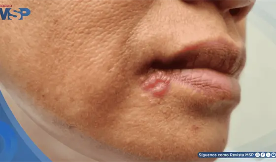 El virus del herpes labial provocar&iacute;a alteraciones celulares propias del alzh&eacute;imer en neuronas humanas