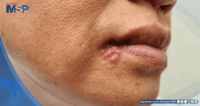 El virus del herpes labial provocar&iacute;a alteraciones celulares propias del alzh&eacute;imer en neuronas humanas