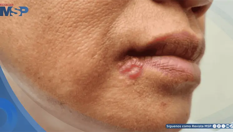 El virus del herpes labial provocar&iacute;a alteraciones celulares propias del alzh&eacute;imer en neuronas humanas