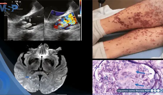 Endocarditis por Lactobacillus debut&oacute; con confusi&oacute;n, afasia, infartos cerebrales y da&ntilde;o renal grave