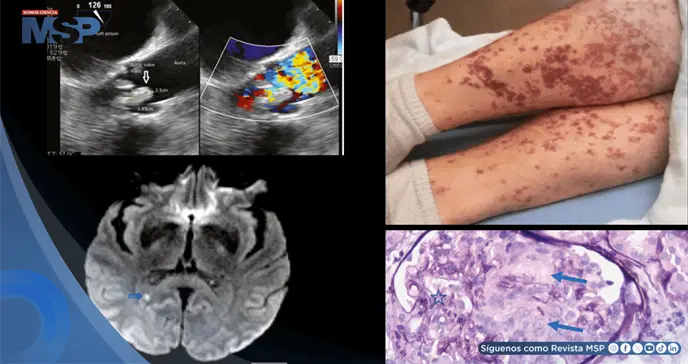 Endocarditis por Lactobacillus debut&oacute; con confusi&oacute;n, afasia, infartos cerebrales y da&ntilde;o renal grave