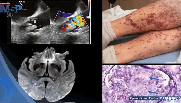 Endocarditis por Lactobacillus debutó con confusión, afasia, infartos cerebrales y daño renal grave Endocarditis por Lactobacillus debutó con confusión, afasia, infartos cerebrales y daño renal grave