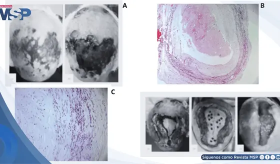 Necrosis extensa del cuero cabelludo como complicación de arteritis de células gigantes