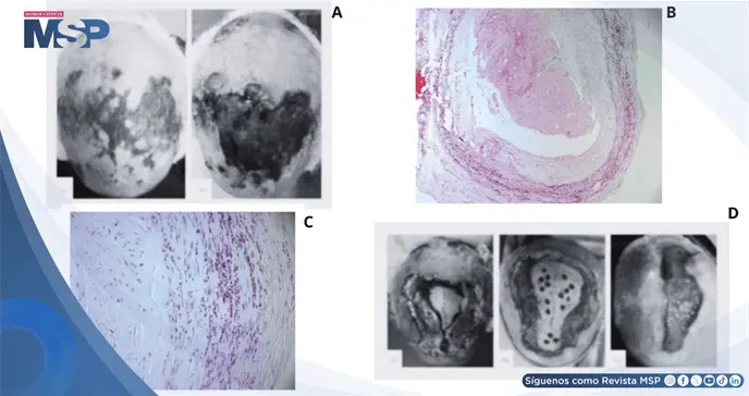 Necrosis extensa del cuero cabelludo como complicaci&oacute;n de arteritis de c&eacute;lulas gigantes