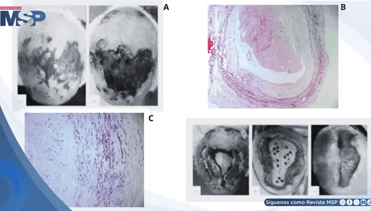 Necrosis extensa del cuero cabelludo como complicación de arteritis de células gigantes Necrosis extensa del cuero cabelludo como complicación de arteritis de células gigantes