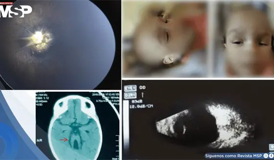 Vasculatura fetal y síndrome de Morning Glory bilateral en lactante de un año con síndrome de Joubert