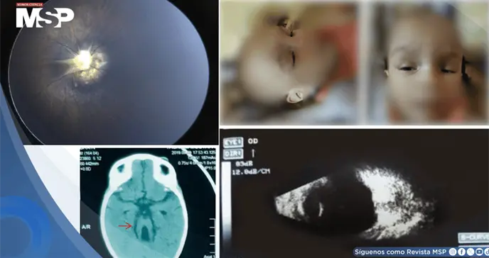 Vasculatura fetal y s&iacute;ndrome de Morning Glory bilateral en lactante de un a&ntilde;o con s&iacute;ndrome de Joubert
