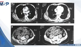 Dolor abdominal con ascitis y autoanticuerpos positivos resultaron en gastroenteritis eosinof&iacute;lica