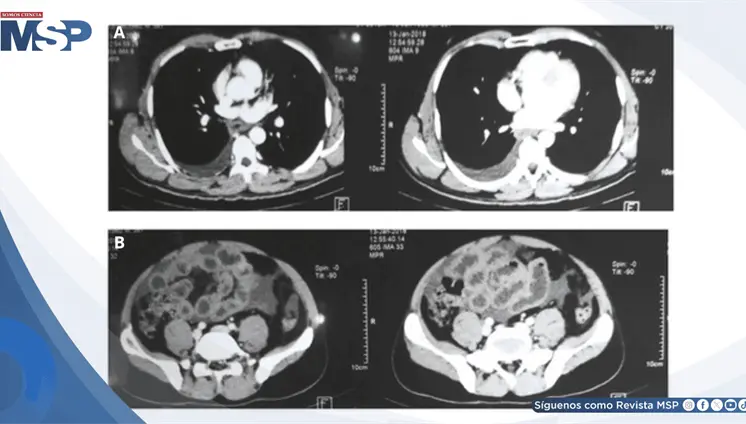 Dolor abdominal con ascitis y autoanticuerpos positivos resultaron en gastroenteritis eosinofílica Dolor abdominal con ascitis y autoanticuerpos positivos resultaron en gastroenteritis eosinofílica