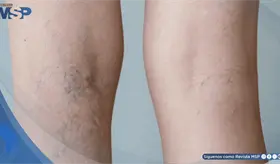 Pesadez, hinchazón y dolor en las piernas: Síntomas de insuficiencia venosa crónica y cómo manejarlos