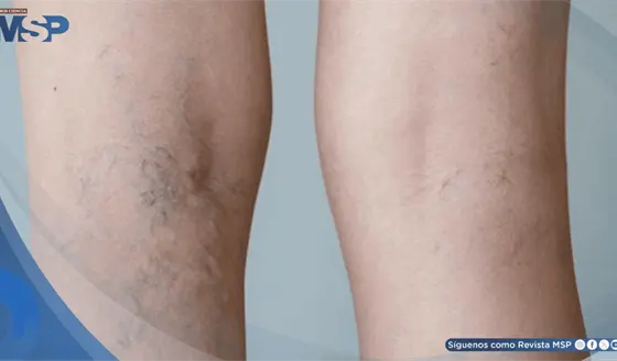 Pesadez, hinchaz&oacute;n y dolor en las piernas: S&iacute;ntomas de insuficiencia venosa cr&oacute;nica y c&oacute;mo manejarlos 