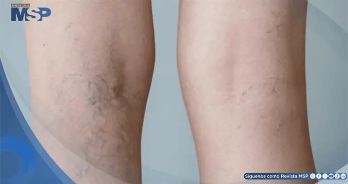 Pesadez, hinchaz&oacute;n y dolor en las piernas: S&iacute;ntomas de insuficiencia venosa cr&oacute;nica y c&oacute;mo manejarlos 