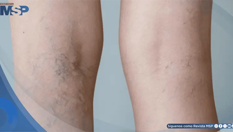 Pesadez, hinchaz&oacute;n y dolor en las piernas: S&iacute;ntomas de insuficiencia venosa cr&oacute;nica y c&oacute;mo manejarlos 