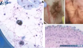Hematuria indolora en adulto mayor revela cistitis por c&aacute;ndida y  hallazgo de pseudomelanosis vesical