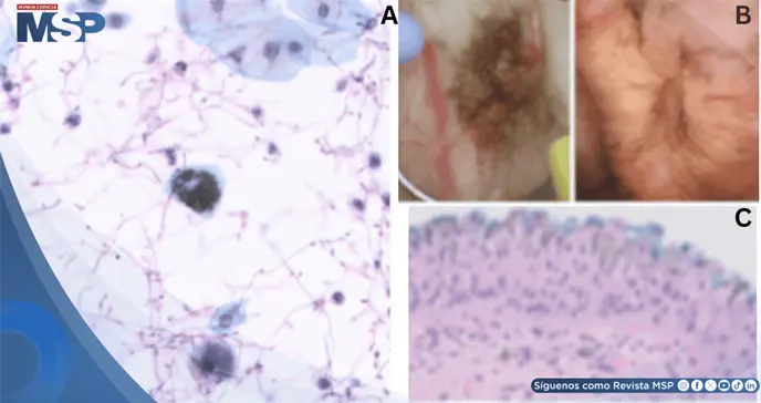 Hematuria indolora en adulto mayor revela cistitis por cándida y hallazgo de pseudomelanosis vesical Hematuria indolora en adulto mayor revela cistitis por cándida y hallazgo de pseudomelanosis vesical