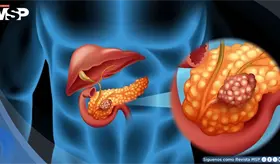 Descubren que la grasa pancre&aacute;tica se asocia a mayor deterioro cerebral, seg&uacute;n estudio