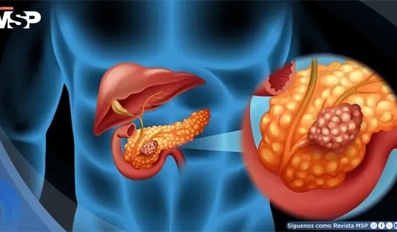 Descubren que la grasa pancre&aacute;tica se asocia a mayor deterioro cerebral, seg&uacute;n estudio