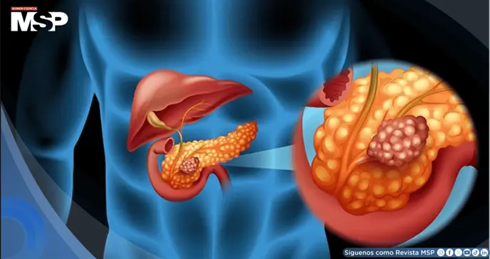 Descubren que la grasa pancre&aacute;tica se asocia a mayor deterioro cerebral, seg&uacute;n estudio