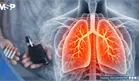 Efectos en la salud del vapeo y el tabaquismo &iquest;Cu&aacute;les son las similitudes y diferencias  cl&iacute;nicas?
