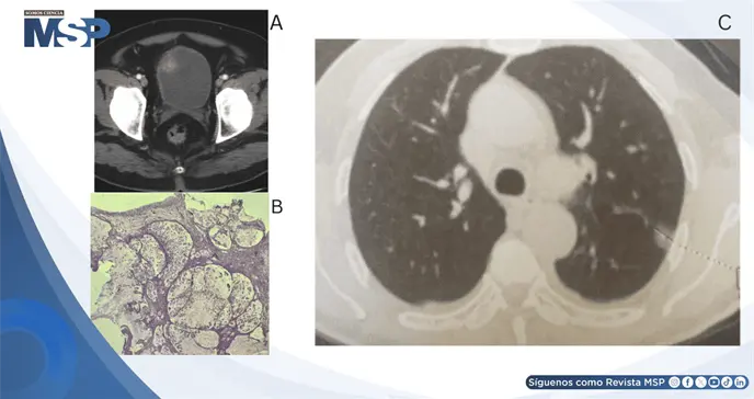 Hematuria revel&oacute; adenocarcinoma mucinoso de c&eacute;lulas en anillo de vejiga con met&aacute;stasis pulmonar y &oacute;sea 