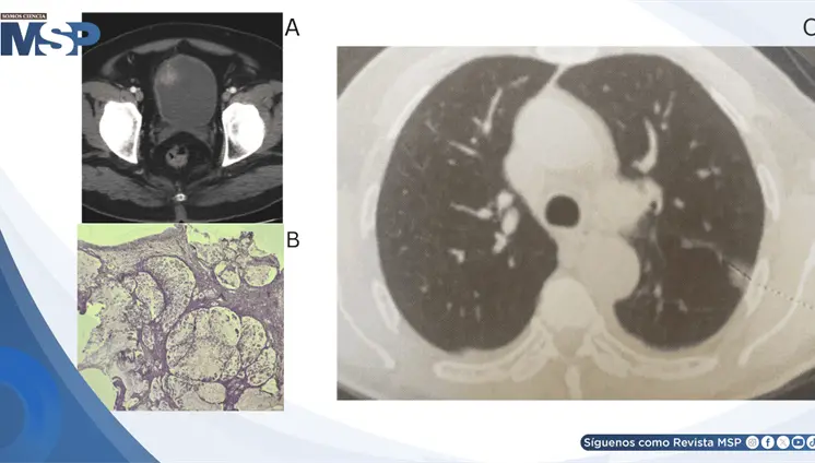 Hematuria reveló adenocarcinoma mucinoso de células en anillo de vejiga con metástasis pulmonar y ósea Hematuria reveló adenocarcinoma mucinoso de células en anillo de vejiga con metástasis pulmonar y ósea