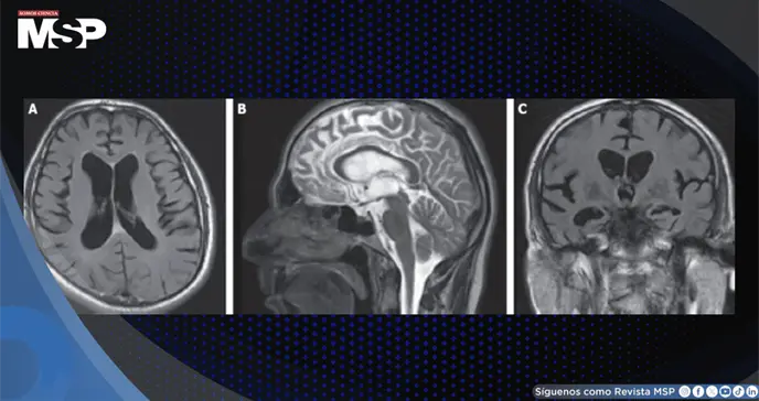 Neuros&iacute;filis con psicosis, demencia e incontinencia tras a&ntilde;os de tratamiento psiqui&aacute;trico sin respuesta