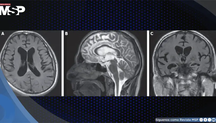 Neurosífilis con psicosis, demencia e incontinencia tras años de tratamiento psiquiátrico sin respuesta Neurosífilis con psicosis, demencia e incontinencia tras años de tratamiento psiquiátrico sin respuesta