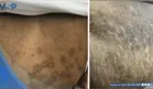 Psoriasis guttata desencadenada por faringitis estreptoc&oacute;cica en paciente con diabetes y c&aacute;ncer de colon