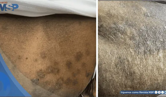 Psoriasis guttata desencadenada por faringitis estreptoc&oacute;cica en paciente con diabetes y c&aacute;ncer de colon