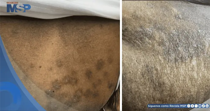 Psoriasis guttata desencadenada por faringitis estreptocócica en paciente con diabetes y cáncer de colon Psoriasis guttata desencadenada por faringitis estreptocócica en paciente con diabetes y cáncer de colon