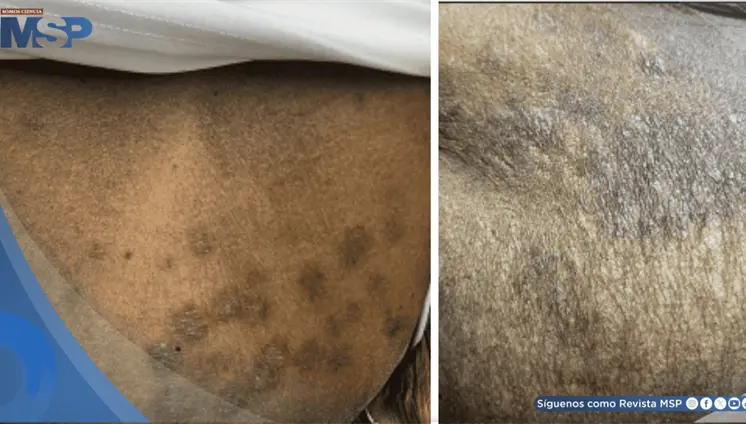 Psoriasis guttata desencadenada por faringitis estreptocócica en paciente con diabetes y cáncer de colon Psoriasis guttata desencadenada por faringitis estreptocócica en paciente con diabetes y cáncer de colon