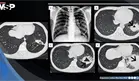 Absceso pulmonar por Rhodococcus revela VIH avanzado no detectado en paciente con fiebre y dolor tor&aacute;cico