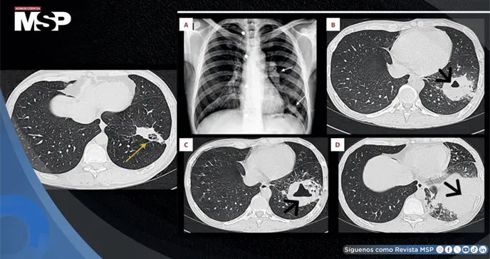 Absceso pulmonar por Rhodococcus revela VIH avanzado no detectado en paciente con fiebre y dolor torácico Absceso pulmonar por Rhodococcus revela VIH avanzado no detectado en paciente con fiebre y dolor torácico