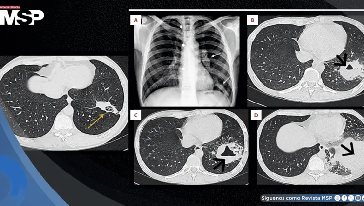 Absceso pulmonar por Rhodococcus revela VIH avanzado no detectado en paciente con fiebre y dolor tor&aacute;cico
