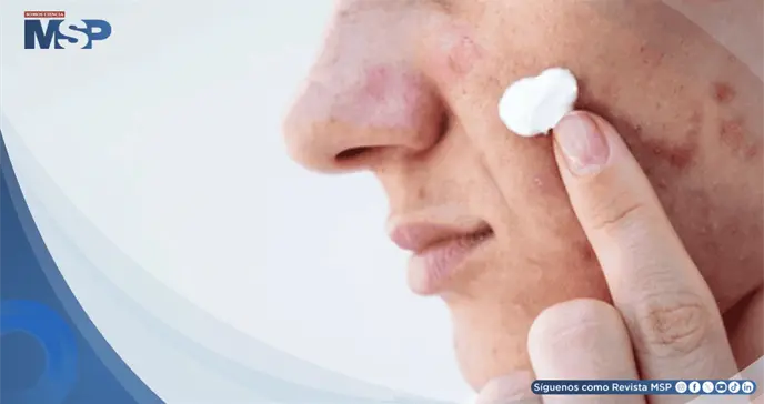 Skincare viral en redes podr&iacute;a causar quemaduras, manchas y hasta lesiones precancer&iacute;genas