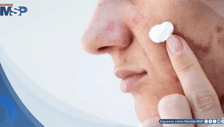 Skincare viral en redes podría causar quemaduras, manchas y hasta lesiones precancerígenas Skincare viral en redes podría causar quemaduras, manchas y hasta lesiones precancerígenas