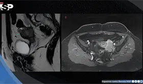 Mujer con dismenorrea y masa anexial fue diagnosticada con carcinoma folicular en estroma ov&aacute;rico