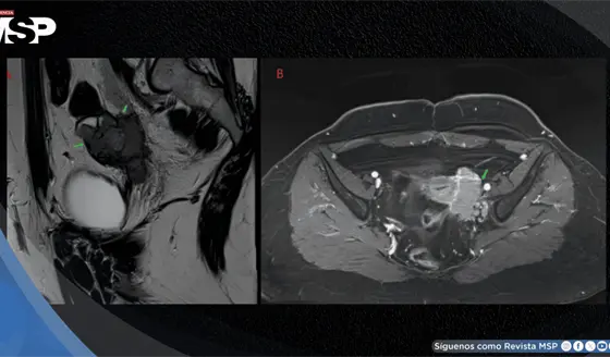 Mujer con dismenorrea y masa anexial fue diagnosticada con carcinoma folicular en estroma ov&aacute;rico