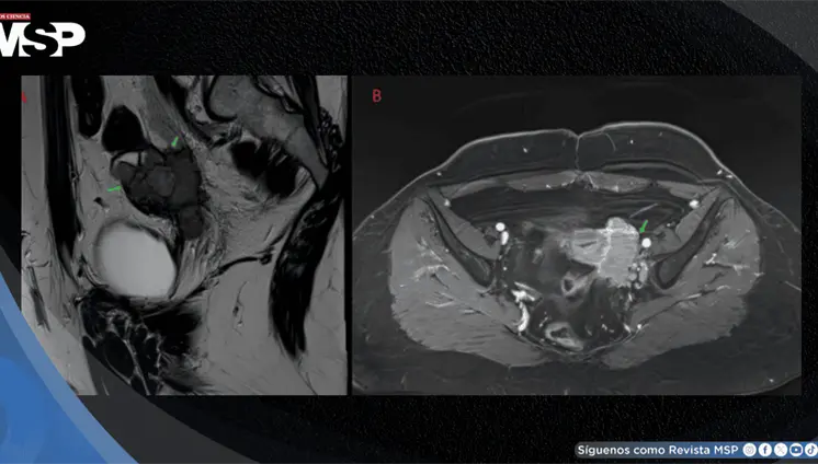 Mujer con dismenorrea y masa anexial fue diagnosticada con carcinoma folicular en estroma ovárico Mujer con dismenorrea y masa anexial fue diagnosticada con carcinoma folicular en estroma ovárico